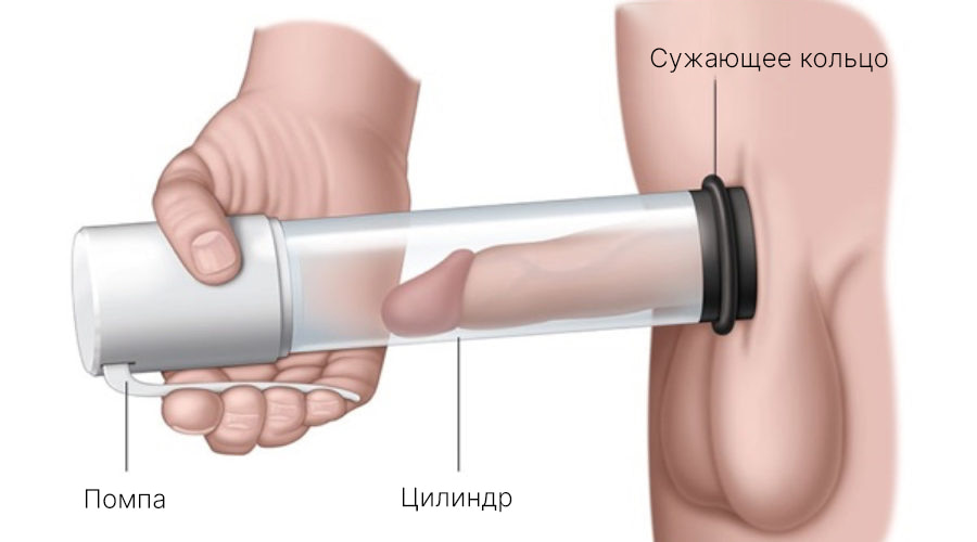 Протезирование полового члена: доступные цены