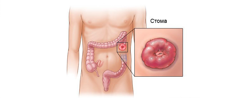 Жизнь со стомой